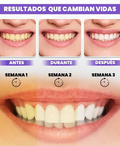SMILEKIT | Blanquedor dental | Tratamiento efectivo contra las manchas amarilllas de los dientes sin causar sensibilidad
